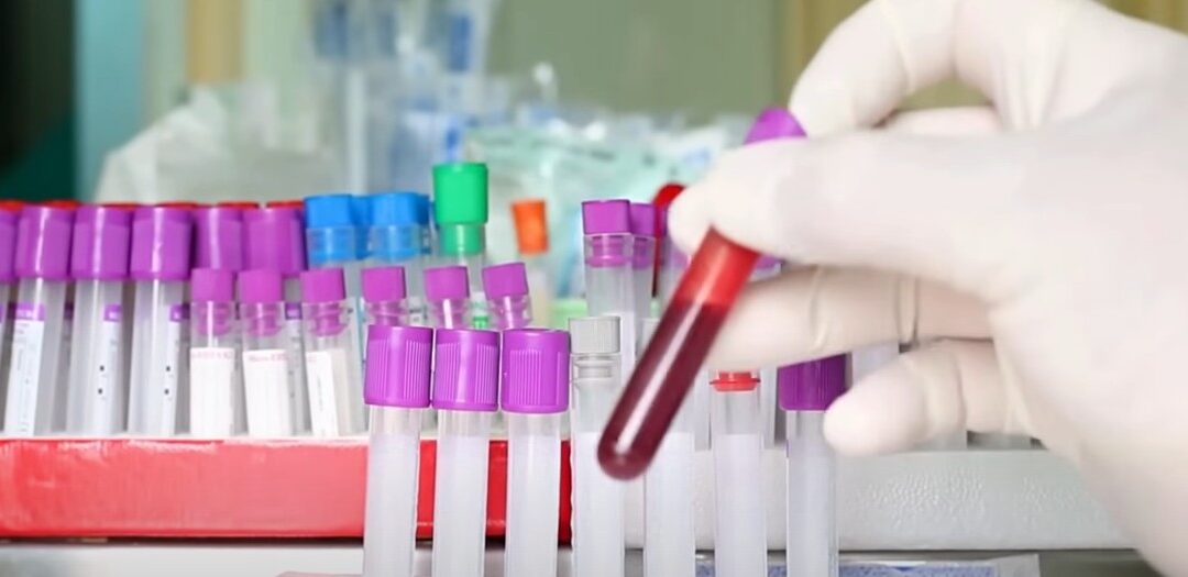 Δείτε το βίντεο “10 Κρυφά Συμπτώματα ΠΡΟΔΙΑΒΗΤΗ που Δεν Πρέπει να Αγνοήσετε!” στο YouTube